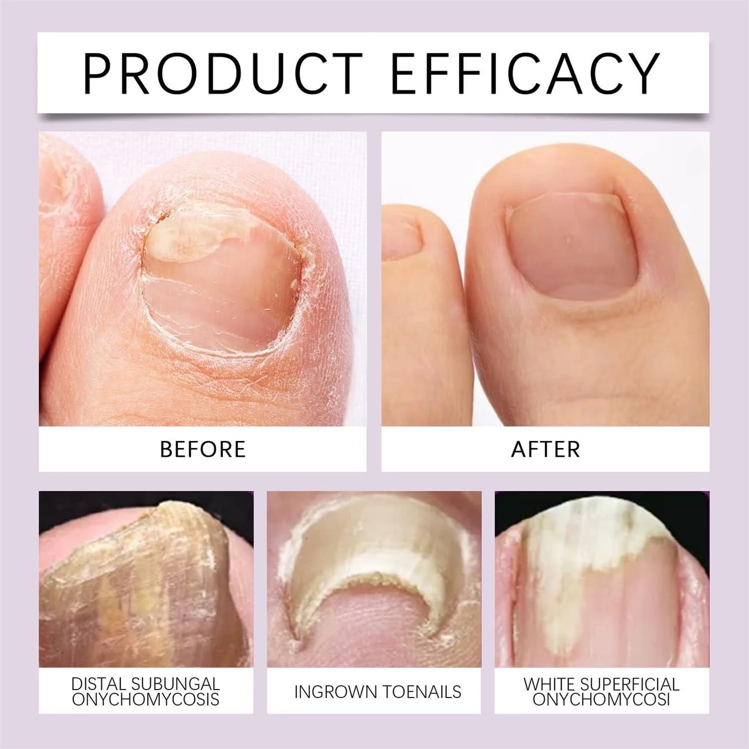 (BUY 1 GET 1 FREE) FungiFree® Bee Venom Nail Treatment Solution Serum - Image 4